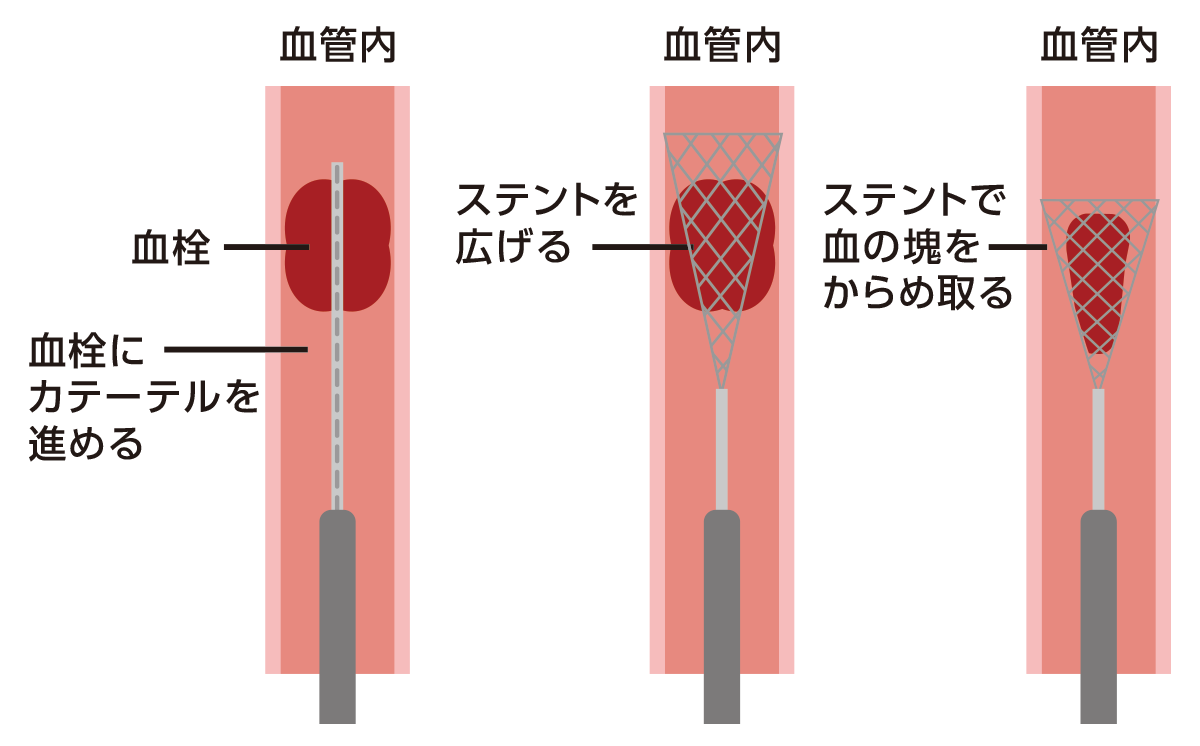 血栓回収療法（カテーテル治療）の流れを表したイラスト。