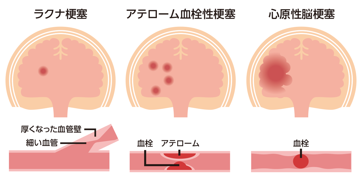 ラクナ梗塞、アテローム血栓性脳梗塞、心原性脳梗塞のそれぞれの特徴を表したイラスト