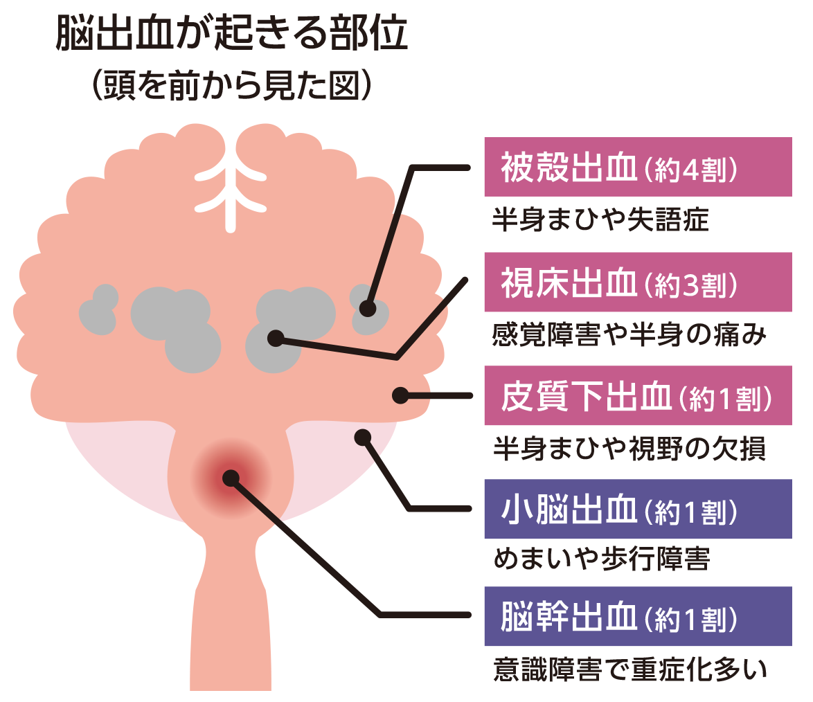 脳出血が起きる部位を表したイラスト。