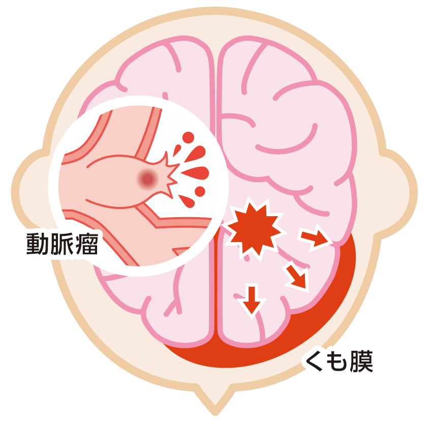 くも膜下出血の原因を表したイラスト。
