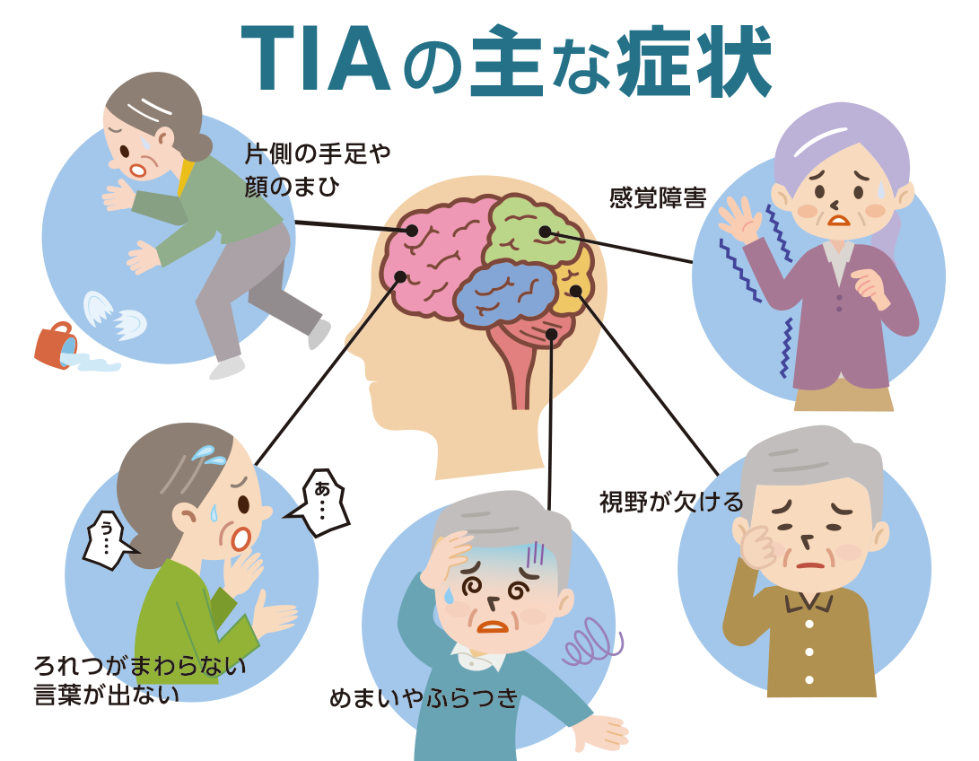TIAの主な症状を表したイラスト。