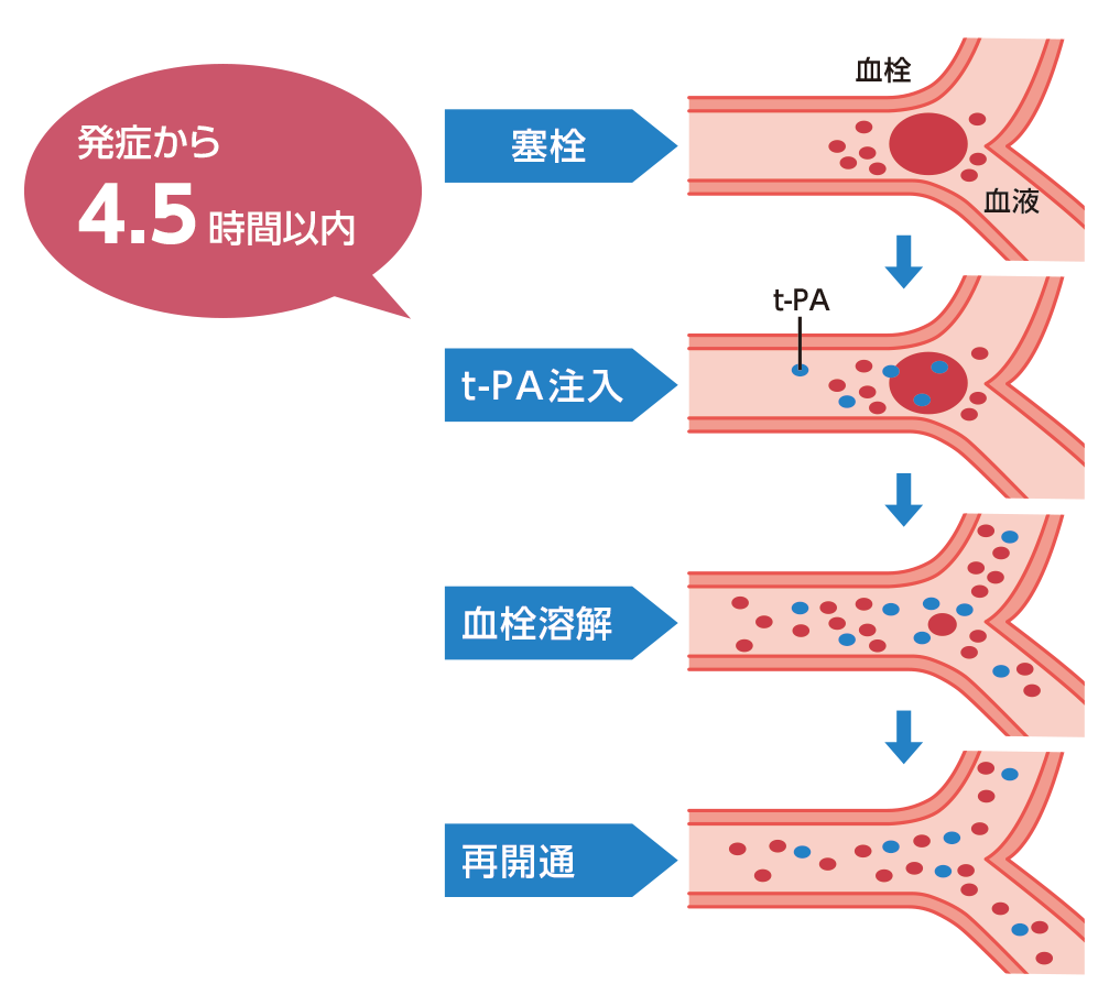 血栓溶解療法（t-PA療法）の流れを表したイラスト。
