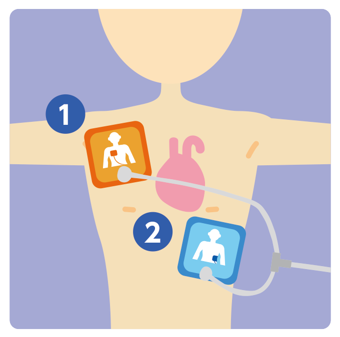図1：AEDパッドの貼り付け場所