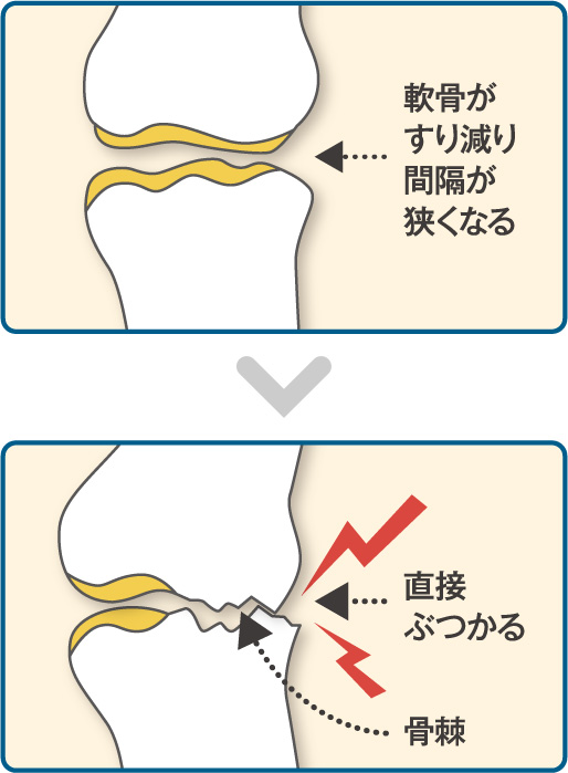 軟骨がすり減り間隔が狭くなる 直接ぶつかる・骨棘（こつきょく）