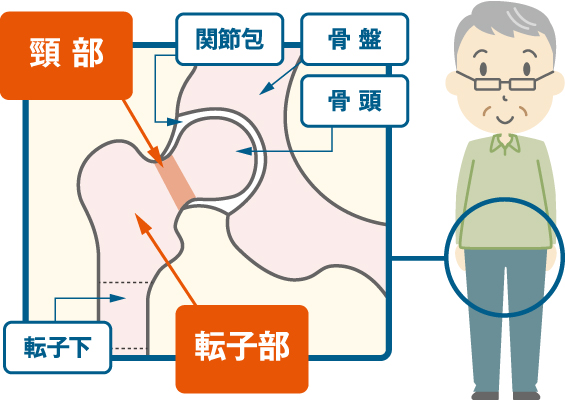 大腿骨（だいたいこつ）の骨頭（こっとう）を支える頸の部分：頸部（けいぶ）、関節包（かんせつほう）、骨盤、骨頭（こっとう）、転子下（てんしか）、転子部（てんしぶ）