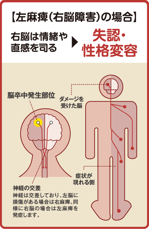 【左麻痺（右脳（うのう）障害）の場合】右脳（うのう）は情緒や直感を司る→失認・性格変容、脳卒中発生部位の場所、神経の交差の場所（神経は交差しており、左脳（さのう）に損傷がある場合右麻痺、同様に右脳（うのう）の場合は左麻痺を発症します）
