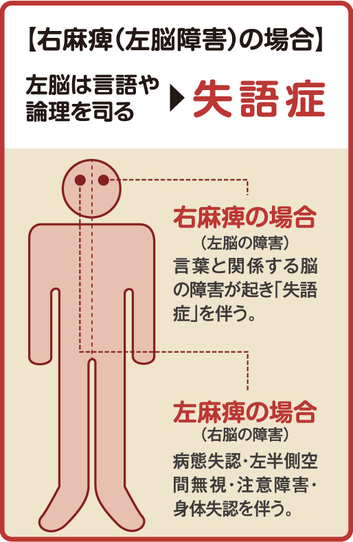 【右麻痺（左脳（さのう）障害）の場合】左脳（さのう）は言語や論理を司る→失語症、右麻痺の場合（左脳（さのう）の障害）言語と関係する脳の障害が起き「失語症」を伴う。左麻痺の場合（右脳（うのう）の障害）病態失認・左半側空間無視（はんそくくうかんむし）・注意障害・身体失認を伴う。