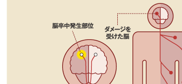脳卒中発生部位　ダメージを受けた脳