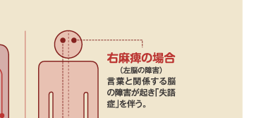 右麻痺の場合（左脳の障害）　言葉と関係する脳の障害が起き「失語症」を伴う。