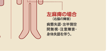 左麻痺の場合（右脳の障害）　病態失認・左半側空間無視・注意障害・身体失認を伴う。