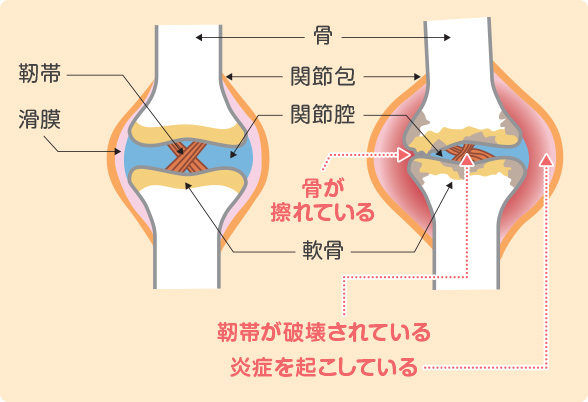 正常時と関節リウマチにおける関節の変化。正常な関節：軟骨はクッションの役割を、関節腔（かんせつくう）を満たす関節液は潤滑油の役割をしています。関節リウマチの関節：滑膜（かつまく）が炎症をおこし、骨や軟骨や靭帯が破壊されてしまいます。骨が擦れている、靭帯が破壊されている、炎症を起こしている。