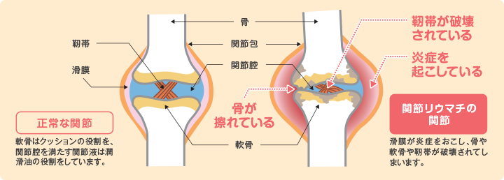 正常時と関節リウマチにおける関節の変化。正常な関節：軟骨はクッションの役割を、関節腔（かんせつくう）を満たす関節液は潤滑油の役割をしています。関節リウマチの関節：滑膜（かつまく）が炎症をおこし、骨や軟骨や靭帯が破壊されてしまいます。骨が擦れている、靭帯が破壊されている、炎症を起こしている。