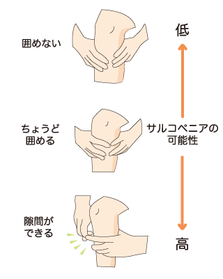 サルコペニアのセルフチェック「指輪っかテスト」のやり方： 両手の親指と人差し指で輪をつくり、ふくらはぎの一番太い部分に合わせます。「ふくらはぎをかこめない」「ちょうどかこめる」という方（かた）はサルコペニアの可能性は低いですが、「しっかりと指が重なる」「ふくらはぎと輪の間にすきまができる」という方（かた）は、サルコペニアの可能性が高いです。